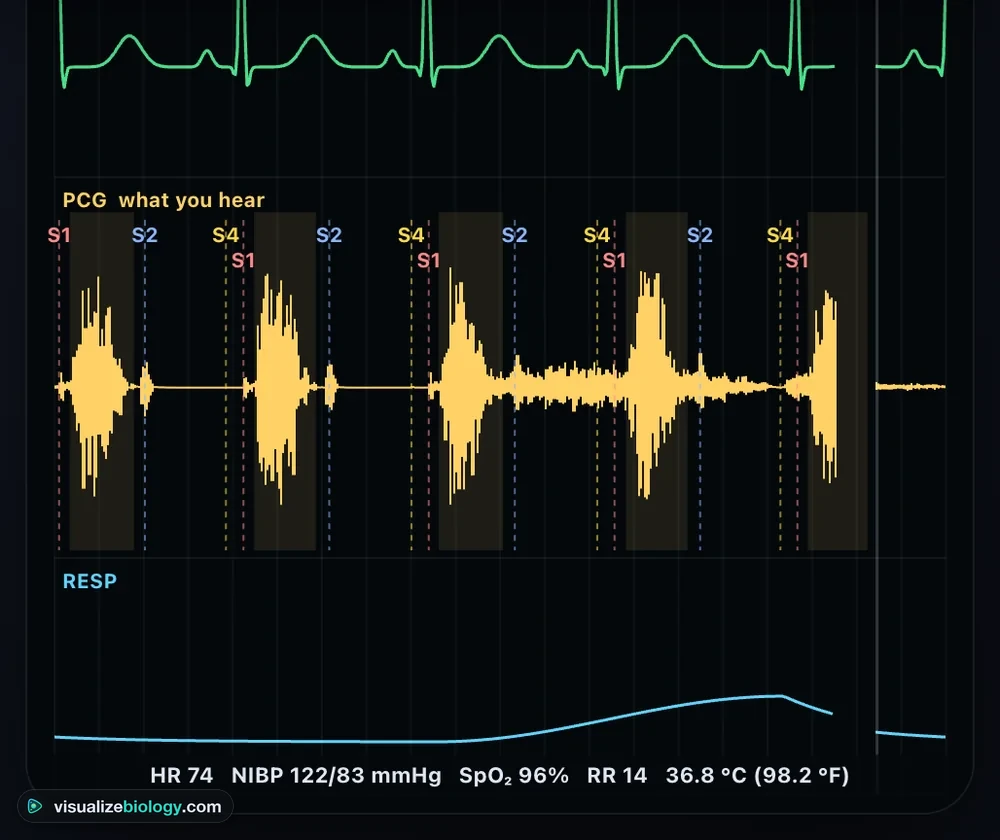 The simulator's monitor at the aortic area of a patient with severe aortic stenosis: the ECG above a phonocardiogram in which a diamond-shaped crescendo–decrescendo murmur fills each systole between S1 and S2, with an S4 before each S1, and the breathing trace below