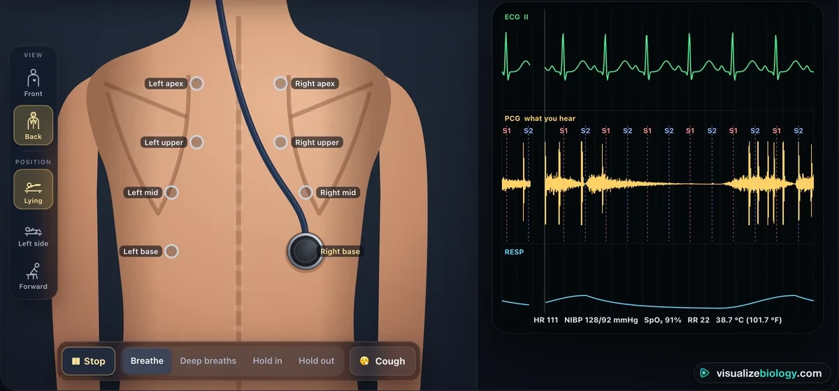 The back of the patient in the simulator with the lung listening sites labelled from the apices to the bases, the chest piece on the right base of a patient with right lower lobe pneumonia, and the monitor's sound trace showing loud breath sounds broken by the sharp spikes of crackles while breathing in