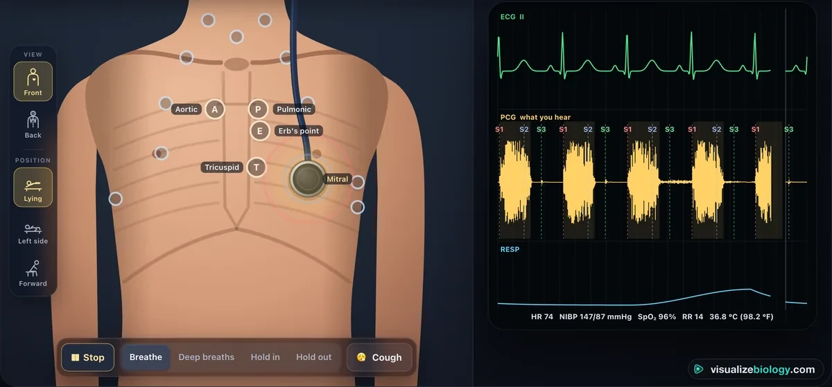 The simulator listening at the mitral area of a patient with mitral regurgitation: the chest with the five heart listening posts labelled, the chest piece on the apex with sound rings, and a bedside monitor showing the ECG, a phonocardiogram with S1, S2 and S3 marked and a murmur filling systole, the breathing trace and the vitals